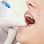 Botox in Dentistry: Unveiling Its Role in Reducing Gum Line Visibility