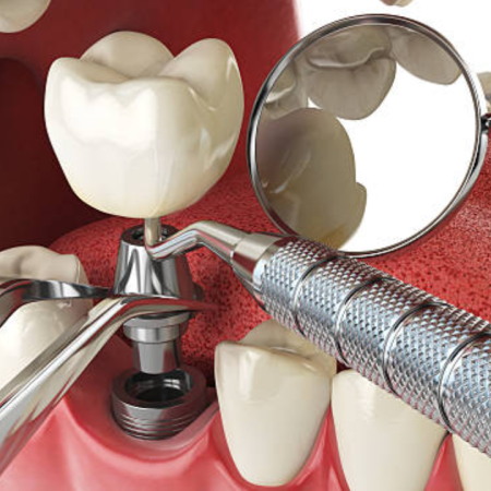 The Role of Dental Implants in Preventing Oral Bone Loss