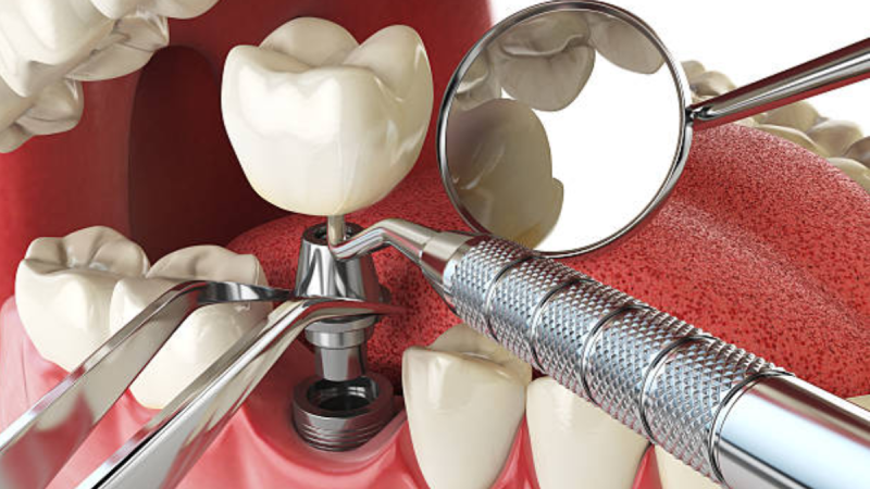 The Role of Dental Implants in Preventing Oral Bone Loss