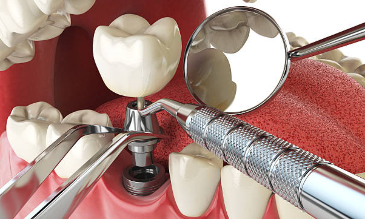 The Role of Dental Implants in Preventing Oral Bone Loss